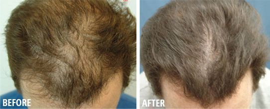 Male Hair Loss Results Roseville