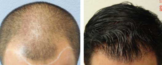Before and After Hair Grafting