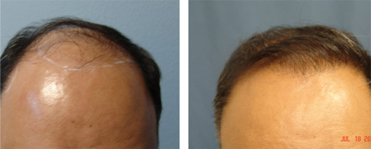 Male Hair Loss Before and After - Sacramento, CA