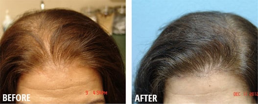 Female Hair Loss Roseville | Hair Thinning For Women Sacramento