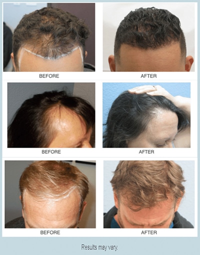 hair transplants Sacramento