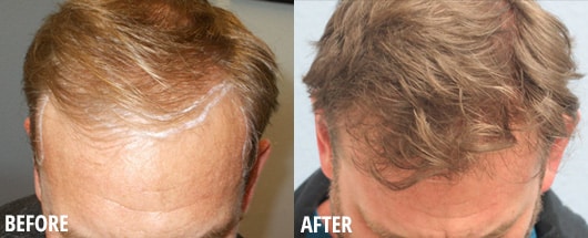 Male FUE Before and After - Sacramento, CA - Sacramento, CA