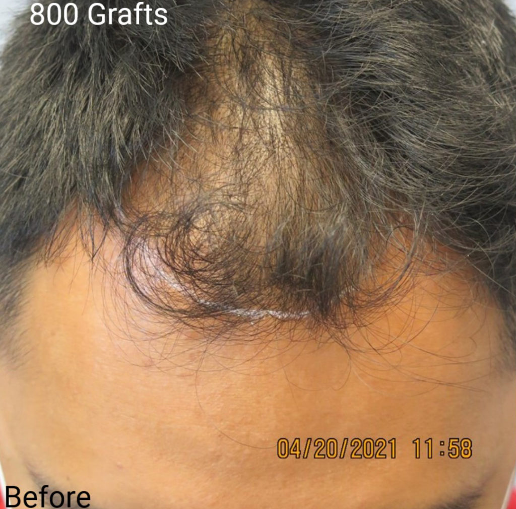 FUT Treatment Roseville | Hair Grafting Sacramento