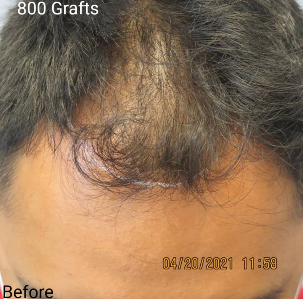 FUT Treatment Roseville | Hair Grafting Sacramento FUT Treatment Roseville | Hair Grafting Sacramento