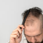 Hair Transplant Surgery: What Men Need to Know