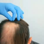 How FUE Hair Transplant Can Help Combat Male and Female Pattern Baldness