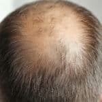 Can Laser Hair Therapy Prevent Future Hair Loss?